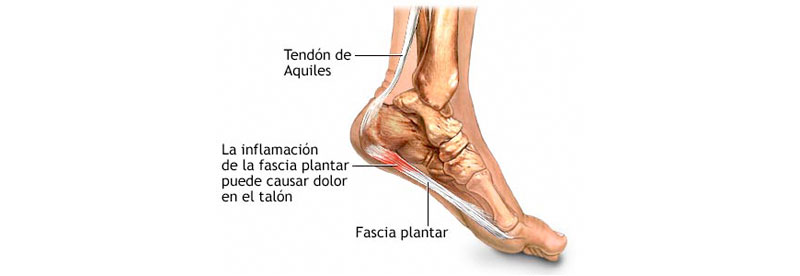 Fascitis Plantar: La lesión del verano - Fisioterapia Granada
